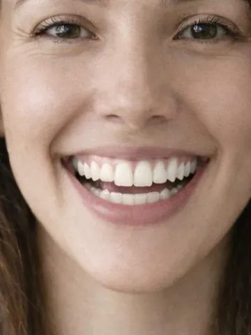 Hollywood Smile example