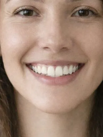 Teeth Straightening example