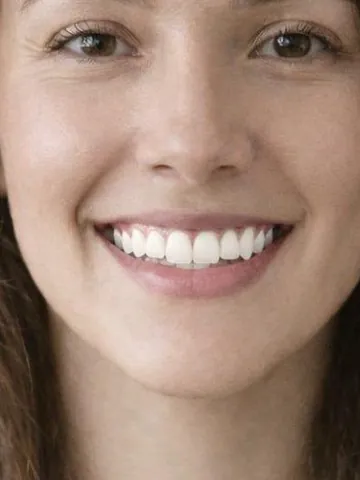 Teeth Whitening example